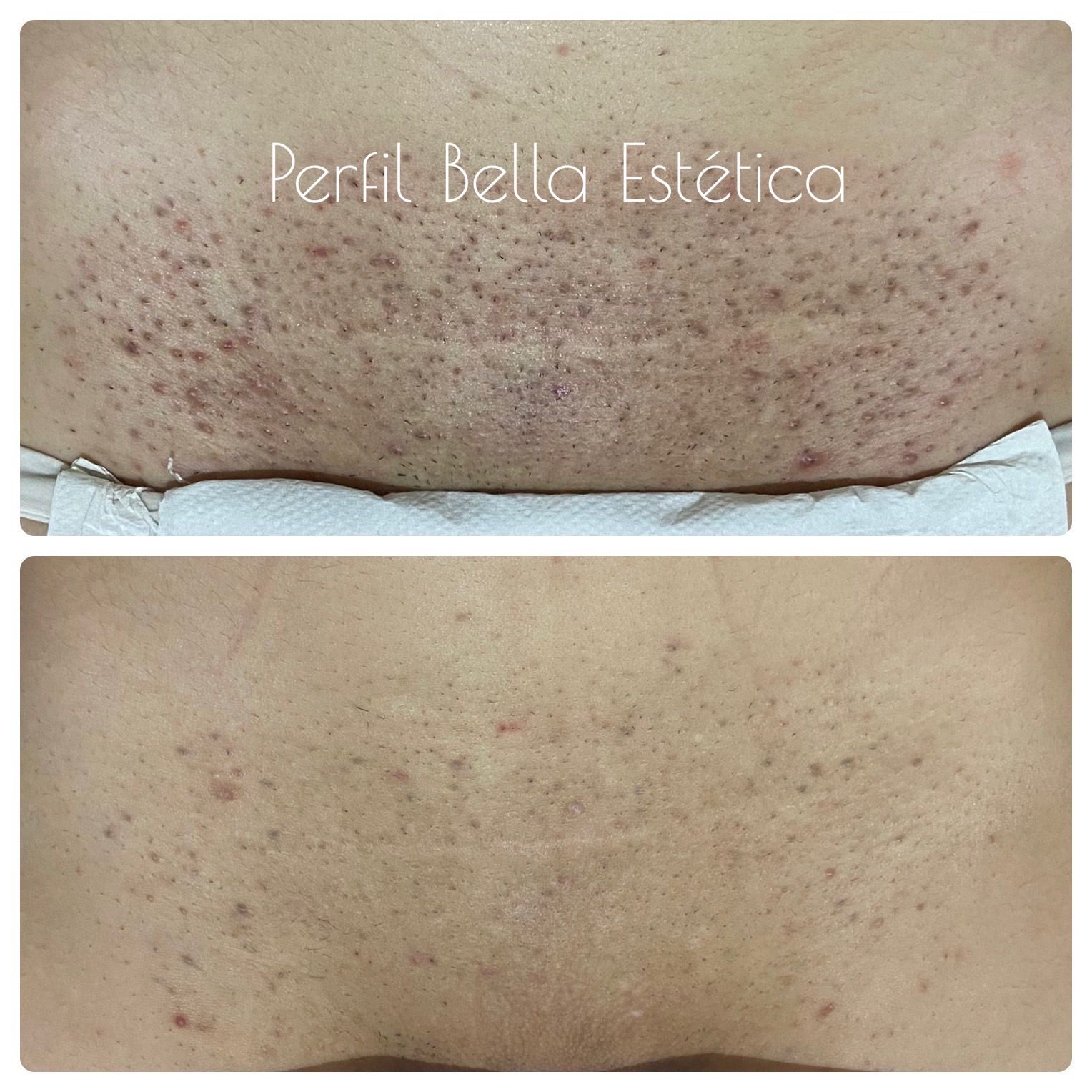 Depilação a Laser Ácrus Depilação a Laser Ácrus