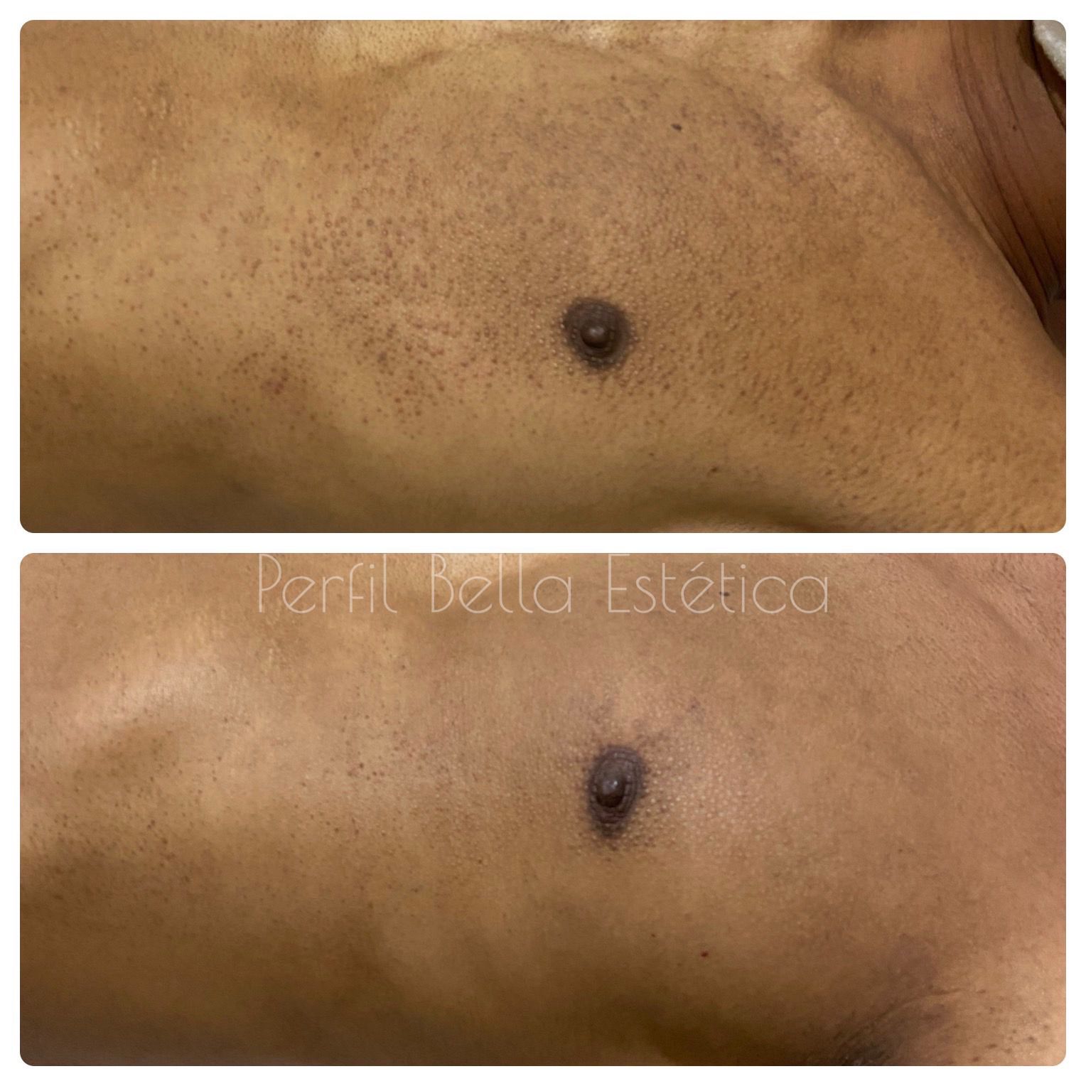 Depilação a Laser Ácrus Depilação a Laser Ácrus