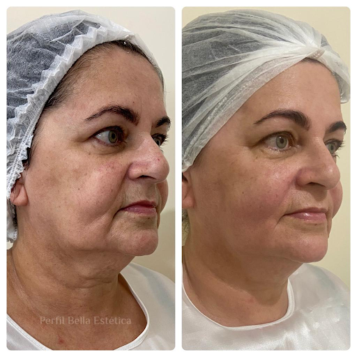 Tratamento para Flacidez Facial no Macedo Tratamento para Flacidez Facial no Macedo